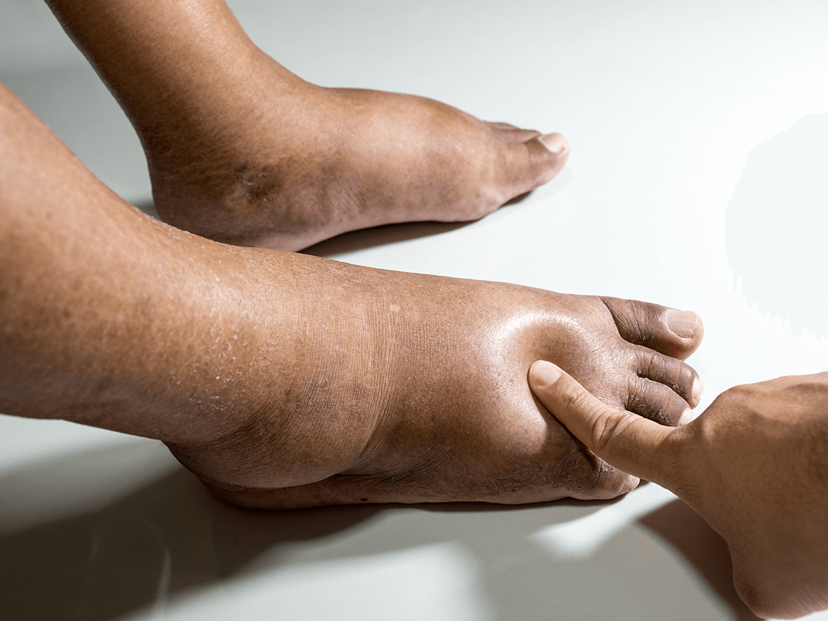 Poor Circulation in the Legs and Feet – What you Should Know